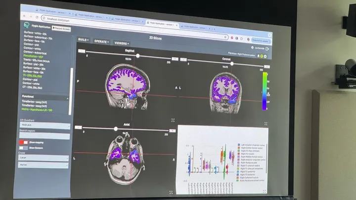 Neurochirurgie : les promesses du cerveau numérique